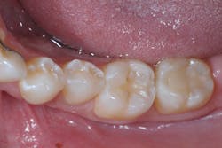 Figure 7b: Pre-op radiograph and clinical photo Figure 7b: Pre-op radiograph and clinical photo