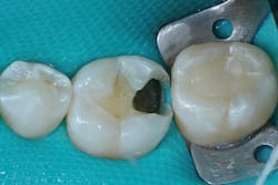 Figure 8a: Caries removal on tooth no. 19. Note the cavitated caries lesion on the mesial surface of tooth no. 18. Figure 8a: Caries removal on tooth no. 19. Note the cavitated caries lesion on the mesial surface of tooth no. 18.