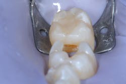 Figure 8b: Caries removal on tooth no. 19. Note the cavitated caries lesion on the mesial surface of tooth no. 18. Figure 8b: Caries removal on tooth no. 19. Note the cavitated caries lesion on the mesial surface of tooth no. 18.