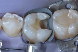 Figure 9: Placement of the matrix band for deep margin elevation. Note that no wedge is placed. Figure 9: Placement of the matrix band for deep margin elevation. Note that no wedge is placed.
