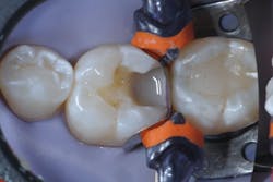 Figure 10a: Once deep marginal elevation is achieved, the tooth is restored as a traditional class II restoration. Figure 10a: Once deep marginal elevation is achieved, the tooth is restored as a traditional class II restoration.