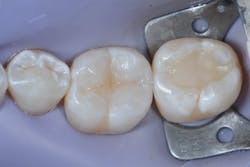 Figure 10b: Once deep marginal elevation is achieved, the tooth is restored as a traditional class II restoration.