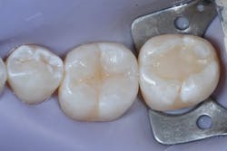 Figure 10b: Once deep marginal elevation is achieved, the tooth is restored as a traditional class II restoration. Figure 10b: Once deep marginal elevation is achieved, the tooth is restored as a traditional class II restoration.