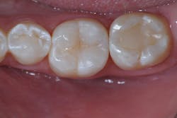 Figure 11a: Post-op radiograph and clinical photo. Note the difference in radiopacities of the composite resins where deep margin elevation was performed. Also note the mesial restoration on tooth no. 19: the marginal ridge was left intact.