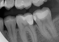 Figure 11b: Post-op radiograph and clinical photo. Note the difference in radiopacities of the composite resins where deep margin elevation was performed. Also note the mesial restoration on tooth no. 19: the marginal ridge was left intact.