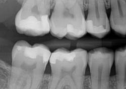 Figure 13a: Tooth no. 2: note the concave contour of the cervical aspect of the restoration due to the placement of a wedge. Figure 13a: Tooth no. 2: note the concave contour of the cervical aspect of the restoration due to the placement of a wedge.
