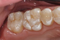 Figure 14: Post-op no. 2: Note the differences in radiopacities in the composite resin used for deep margin elevation and the indirect restorative material. Figure 14: Post-op no. 2: Note the differences in radiopacities in the composite resin used for deep margin elevation and the indirect restorative material.