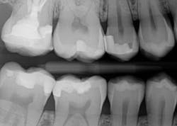 Figure 13b: Tooth no. 2: note the concave contour of the cervical aspect of the restoration due to the placement of a wedge. Figure 13b: Tooth no. 2: note the concave contour of the cervical aspect of the restoration due to the placement of a wedge.