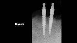 Figure 1: Example image showing lack of peri-implantitis around long-term SDIs Figure 1: Example image showing lack of peri-implantitis around long-term SDIs