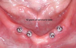 Figure 2: Only about 1 mm bone on facial and lingual of implants and clinical success for many years to date without crestal bone removal
