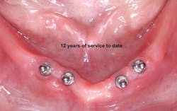 Figure 2: Only about 1 mm bone on facial and lingual of implants and clinical success for many years to date without crestal bone removal Figure 2: Only about 1 mm bone on facial and lingual of implants and clinical success for many years to date without crestal bone removal