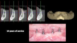 Figure 5: Successful use of 2 mm diameter SDIs in 4-plus mm of bone facial lingual