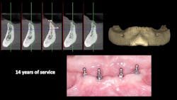 Figure 5: Successful use of 2 mm diameter SDIs in 4-plus mm of bone facial lingual Figure 5: Successful use of 2 mm diameter SDIs in 4-plus mm of bone facial lingual