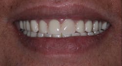 Figure 6: A happy patient with SDIs retaining and supporting her mandibular denture
