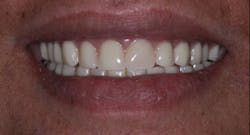 Figure 6: A happy patient with SDIs retaining and supporting her mandibular denture Figure 6: A happy patient with SDIs retaining and supporting her mandibular denture