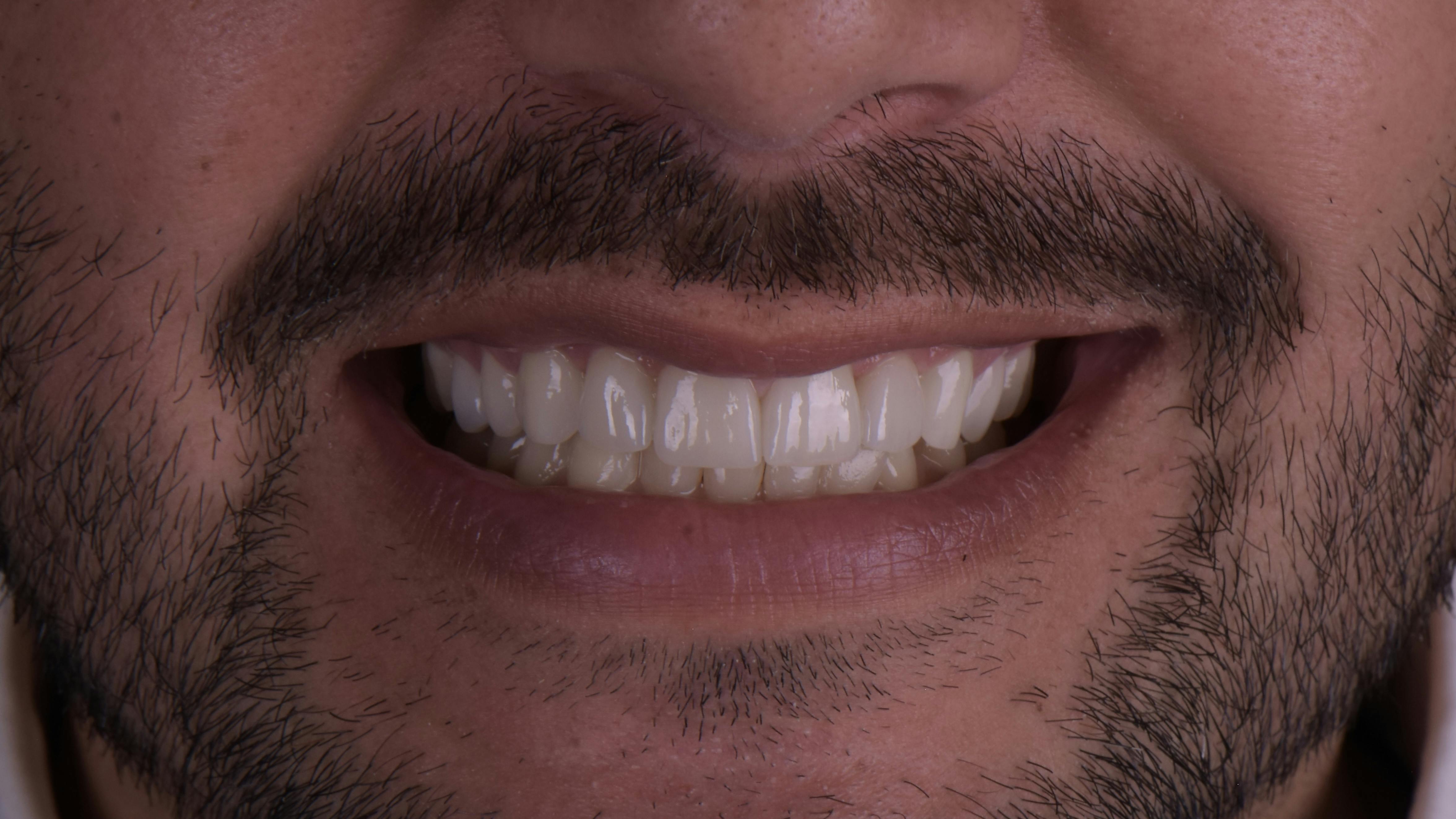 Figure 1: Can you tell if these are natural teeth, lithium disilicate, or zirconia restorations?