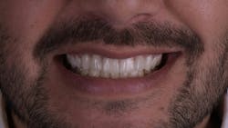 Figure 1: Can you tell if these are natural teeth, lithium disilicate, or zirconia restorations?