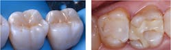 Figure 1: Composite restorations start out looking great (left), but just a few years later the margins are visibly open, encouraging new caries (right).