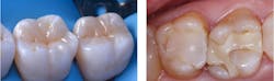 Figure 1: Composite restorations start out looking great (left), but just a few years later the margins are visibly open, encouraging new caries (right). Figure 1: Composite restorations start out looking great (left), but just a few years later the margins are visibly open, encouraging new caries (right).