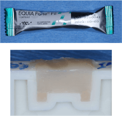 Figure 6: Placing a cariostatic conventional glass ionomer restorative in the deepest portion of the box forms ensures a nonshrinking seal at this most-likely new caries site. This technique is especially important for patients with high caries activity, such as elderly patients or teenagers demonstrating inadequate hygiene.
