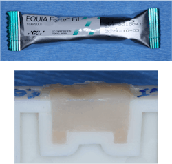 Figure 6: Placing a cariostatic conventional glass ionomer restorative in the deepest portion of the box forms ensures a nonshrinking seal at this most-likely new caries site. This technique is especially important for patients with high caries activity, such as elderly patients or teenagers demonstrating inadequate hygiene. Figure 6: Placing a cariostatic conventional glass ionomer restorative in the deepest portion of the box forms ensures a nonshrinking seal at this most-likely new caries site. This technique is especially important for patients with high caries activity, such as elderly patients or teenagers demonstrating inadequate hygiene.