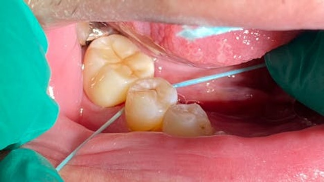 Figure 1: Cocolab’s Cocofloss allows for excellent grabbing and cleaning of interproximal crown cement. Postcementation radiographs have been, on average, freer of remaining cement.