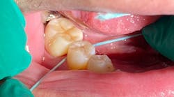Figure 1: Cocolab’s Cocofloss allows for excellent grabbing and cleaning of interproximal crown cement. Postcementation radiographs have been, on average, freer of remaining cement. Figure 1: Cocolab’s Cocofloss allows for excellent grabbing and cleaning of interproximal crown cement. Postcementation radiographs have been, on average, freer of remaining cement.