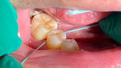 Figure 1: Cocolab’s Cocofloss allows for excellent grabbing and cleaning of interproximal crown cement. Postcementation radiographs have been, on average, freer of remaining cement. Figure 1: Cocolab’s Cocofloss allows for excellent grabbing and cleaning of interproximal crown cement. Postcementation radiographs have been, on average, freer of remaining cement.