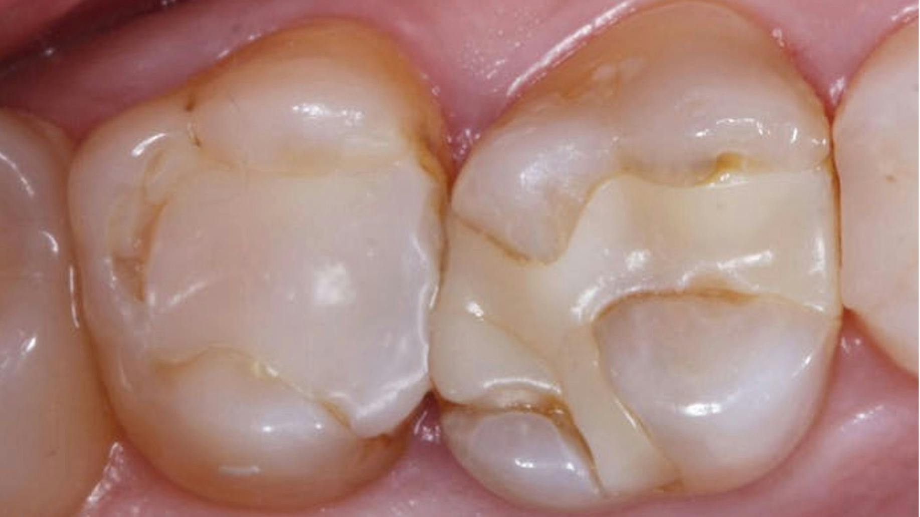 recurrent-caries