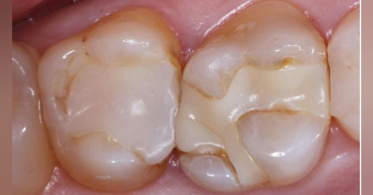 Reducing recurrent caries in composite restorations | Dental Economics