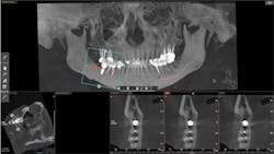 Figure 2: Cone beam images are one of the most valuable methods to educate patients about implant treatment and other dental issues.