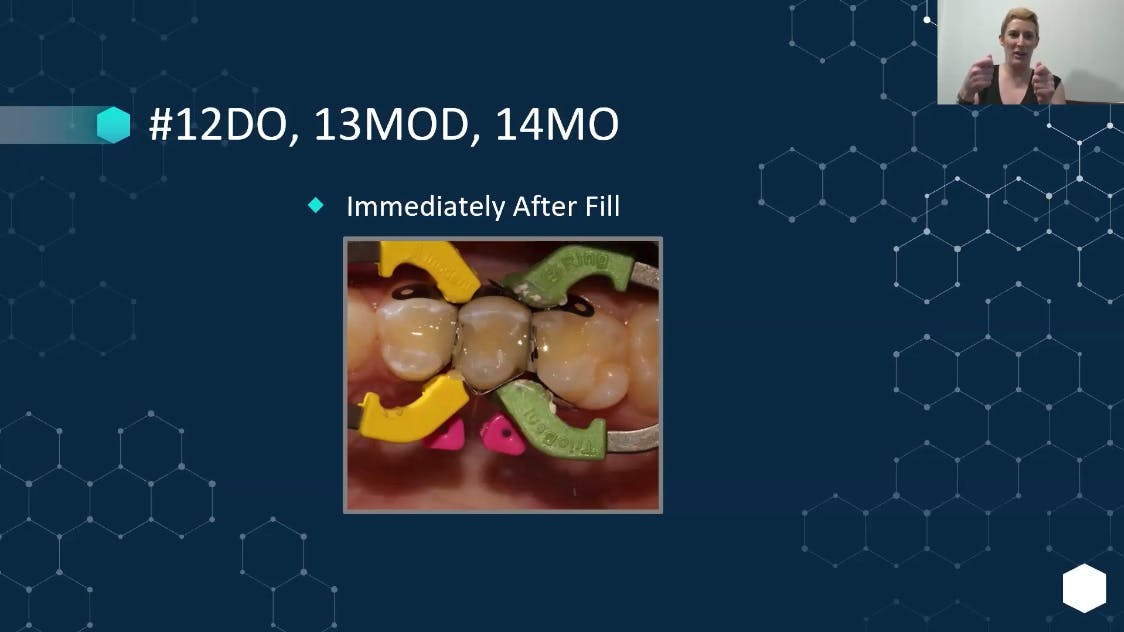 Discover how bioactive composites can transform your practice with improved clinical outcomes and increased efficiency.