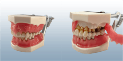 Figure 2: This Kilgore periodontal disease model is one of the best ways to get patients to understand that periodontal disease, while relatively painless, is a real potential problem. Figure 2: This Kilgore periodontal disease model is one of the best ways to get patients to understand that periodontal disease, while relatively painless, is a real potential problem.