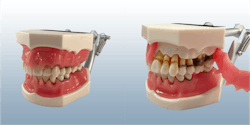 Figure 2: This Kilgore periodontal disease model is one of the best ways to get patients to understand that periodontal disease, while relatively painless, is a real potential problem. Figure 2: This Kilgore periodontal disease model is one of the best ways to get patients to understand that periodontal disease, while relatively painless, is a real potential problem.