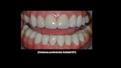 Figure 6: PFM crowns on the maxillary (now in service more than 30 years). Zirconia-base crowns on the mandibular (now in service for 24 years). Cemented with conventional GI cement. Figure 6: PFM crowns on the maxillary (now in service more than 30 years). Zirconia-base crowns on the mandibular (now in service for 24 years). Cemented with conventional GI cement.