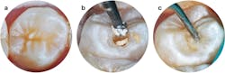 Figures 2a, 2b, and 2c: Preoperative view, carious substance debrided, and cavity disinfected Figures 2a, 2b, and 2c: Preoperative view, carious substance debrided, and cavity disinfected