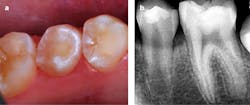 Figures 6a and 6b: Four-month postoperative view and radiograph Figures 6a and 6b: Four-month postoperative view and radiograph