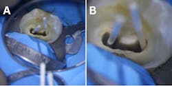 Figure 2: A: Dental microscope low magnification; B: Dental microscope high magnification. Images courtesy of the author. Figure 2: A: Dental microscope low magnification; B: Dental microscope high magnification. Images courtesy of the author.