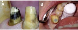 Figure 3: A: Margin preparation under the dental microscope; B: Retractor cord placement under magnification. Images courtesy of Jorge Zapata, DDS. Figure 3: A: Margin preparation under the dental microscope; B: Retractor cord placement under magnification. Images courtesy of Jorge Zapata, DDS.