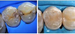 Figure 4: Cavity detection and final restoration under a dental microscope. Images courtesy of Jorge Zapata, DDS. Figure 4: Cavity detection and final restoration under a dental microscope. Images courtesy of Jorge Zapata, DDS.