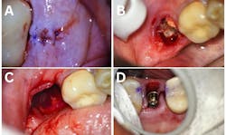 Figure 5: A: Suturing under the dental microscope; B–C: Extraction under the dental microscope; D: Implant placement under the dental microscope. Images courtesy of Jorge Zapata, DDS. Figure 5: A: Suturing under the dental microscope; B–C: Extraction under the dental microscope; D: Implant placement under the dental microscope. Images courtesy of Jorge Zapata, DDS.