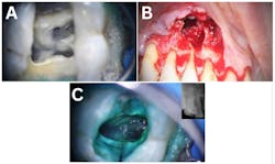 Figure 6: A: Dental microscope high magnification MB2 location; B: Apical micro surgery; C: Vertical fracture detection. Images courtesy of the author. Figure 6: A: Dental microscope high magnification MB2 location; B: Apical micro surgery; C: Vertical fracture detection. Images courtesy of the author.