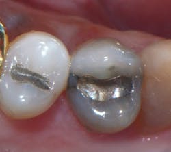Figure 1: Upper right first premolar with occlusal amalgam and two distal marginal ridge fractures and discoloration under the mesial marginal ridge Figure 1: Upper right first premolar with occlusal amalgam and two distal marginal ridge fractures and discoloration under the mesial marginal ridge