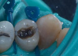 Figure 2: Amalgam removal completed under rubber dam isolation (medium weight dam, prewedging with medium-sized plastic wedges (Palodent, Dentsply). Proximal caries and cracks can be visualized directly. Figure 2: Amalgam removal completed under rubber dam isolation (medium weight dam, prewedging with medium-sized plastic wedges (Palodent, Dentsply). Proximal caries and cracks can be visualized directly.