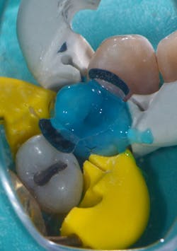Figure 4: Total-etch technique with 37% phosphoric acid with benzalkonium chloride (HV Etch, Bisco) with Universal TwinRing (white, Bioclear Matrix Systems) and Premolar TwinRing (yellow, Bioclear Matrix Systems) separators placed to maximize proximal contacts Figure 4: Total-etch technique with 37% phosphoric acid with benzalkonium chloride (HV Etch, Bisco) with Universal TwinRing (white, Bioclear Matrix Systems) and Premolar TwinRing (yellow, Bioclear Matrix Systems) separators placed to maximize proximal contacts