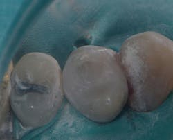 Figure 6: Composite placed, preliminary finishing completed Figure 6: Composite placed, preliminary finishing completed