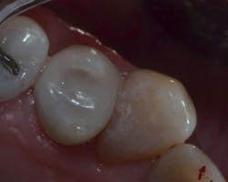 Figure 7: Final polish of the upper first premolar showing rounded proximal contact at the junction of the middle and occlusal thirds of the adjacent premolar Figure 7: Final polish of the upper first premolar showing rounded proximal contact at the junction of the middle and occlusal thirds of the adjacent premolar