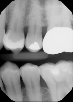 Figure 8: Final polish radiograph of the upper first premolar showing rounded proximal contact at the junction of the middle and occlusal thirds of the adjacent premolar Figure 8: Final polish radiograph of the upper first premolar showing rounded proximal contact at the junction of the middle and occlusal thirds of the adjacent premolar