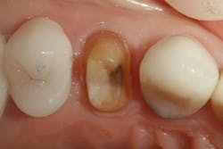 Figure 1: Tooth no. 5 after provisional removal Figure 1: Tooth no. 5 after provisional removal