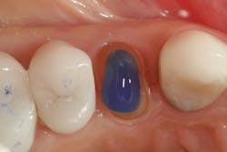 Figure 5: Optional etch with 37% phosphoric acid Figure 5: Optional etch with 37% phosphoric acid